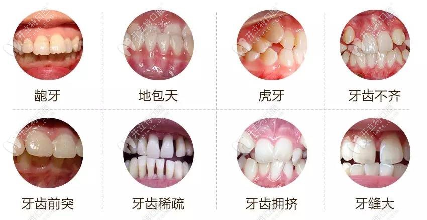 金属牙套可以矫正的畸形牙齿类型