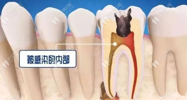 乳牙根管治疗后会对恒牙有影响吗
