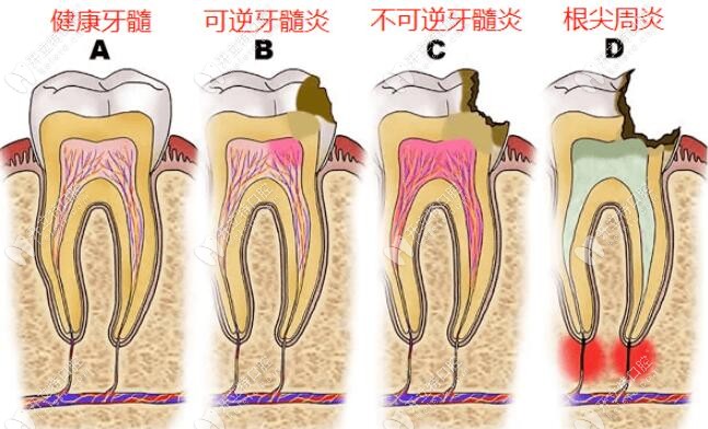 健康牙髓和根尖周炎对比