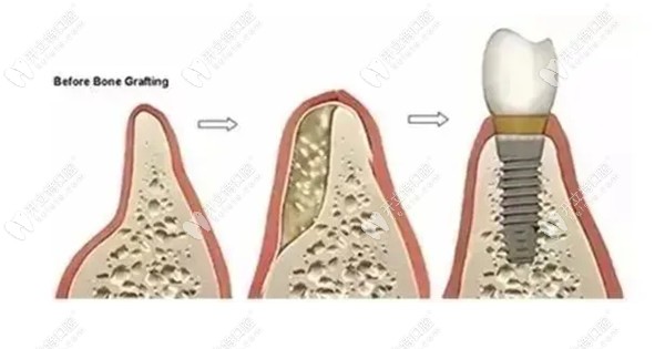 如果种植牙不加骨粉会有什么影响
