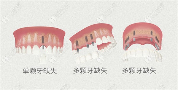 宜賓翠屏區(qū)/南溪區(qū)的種牙費用