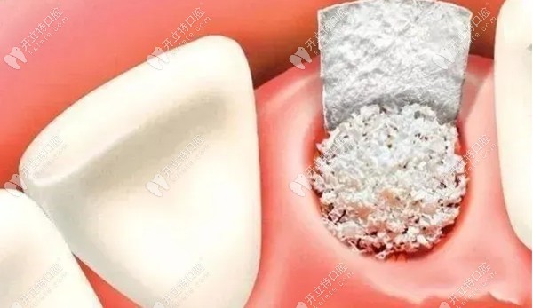 种植牙加骨粉的作用