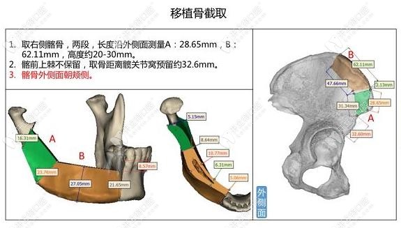 李斌医生能做骨移植种植技术