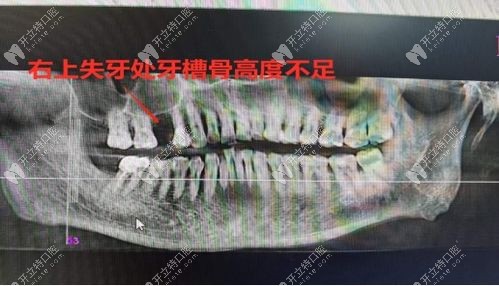 宁波美莱口腔李庆来医生可做牙槽骨骨量不足种植