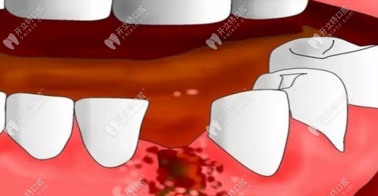 什么是干槽症