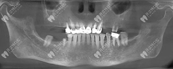 顾客种牙前的口内CT片