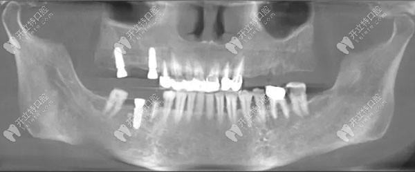 种牙后的口内CT片