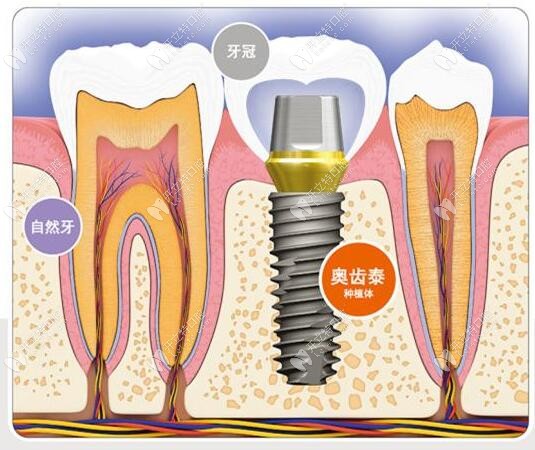 韩国奥齿泰一段式种植体