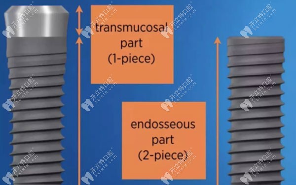 种牙选分段好还是整体好?一段式植体成活率低容易坏是谣言