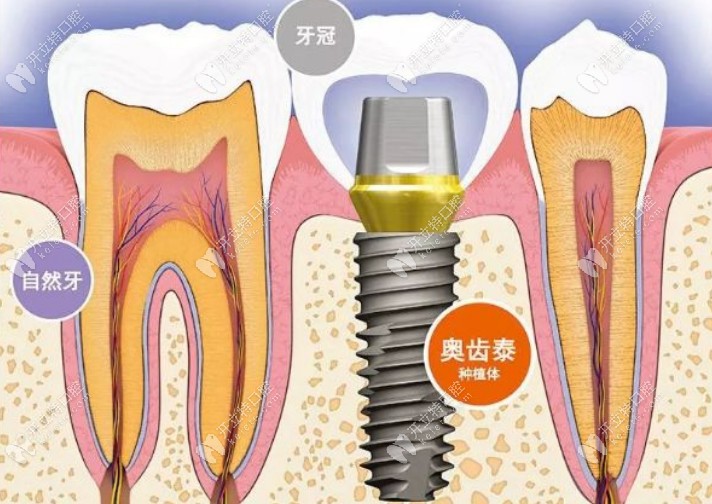 韩国奥齿泰种植牙的质量