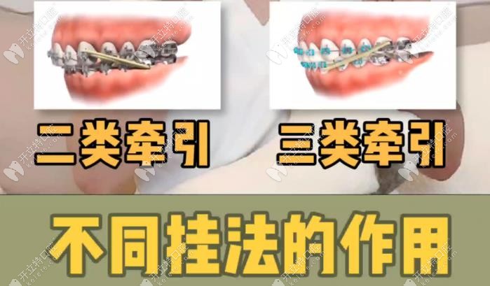 牙齿矫正中的正畸牵引作用是什么?二三类牵引区别很大哟