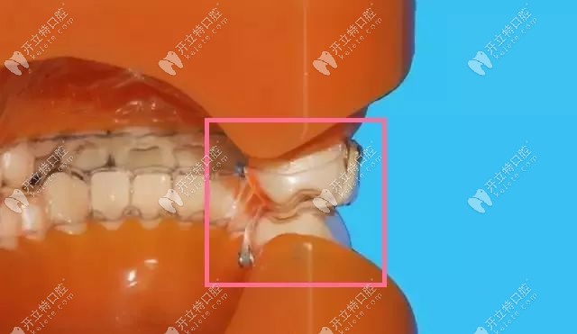 牙齿矫正中的正畸牵引作用是什么二三类牵引区别很大哟