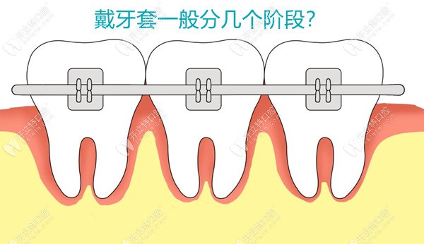 牙齿矫正一般分为哪几个阶段