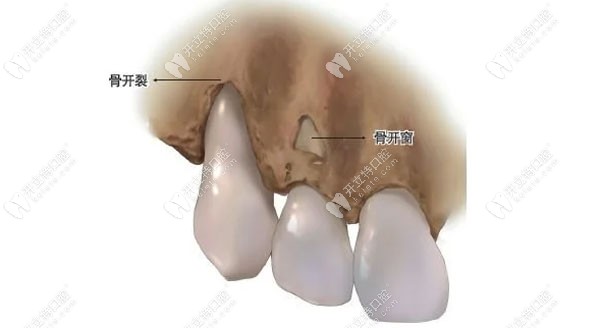 看骨开窗示意图自行判断