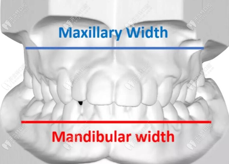 牙齿正畸扩弓器的种类及作用-含适合骨性扩弓的螺旋扩弓器