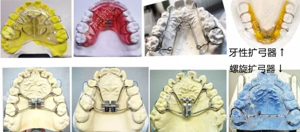 牙性扩弓和螺旋扩弓器的示意图