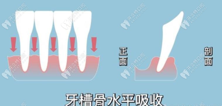 骨水平吸收示意图