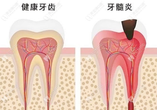 健康牙齿和牙髓炎的对比