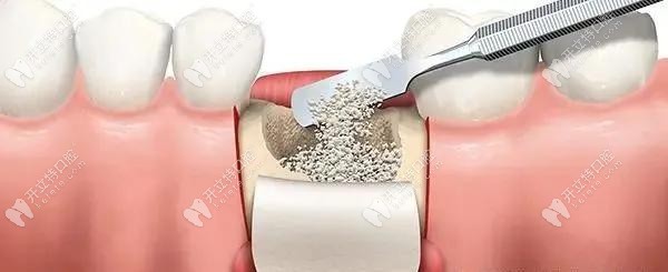 种植牙植骨自体骨移植技术及人工植骨