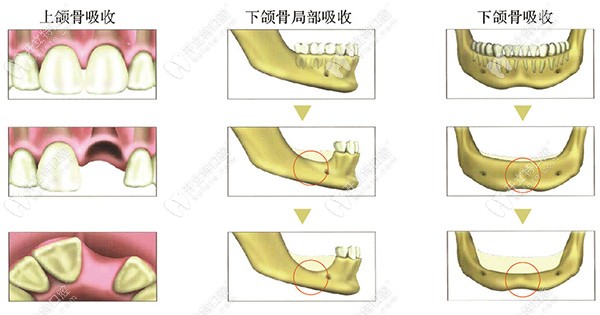 牙齿各部位牙槽骨吸收示意图