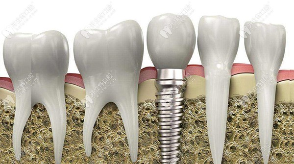 种植牙高度8mm可以种牙吗?由牙槽骨厚度标准决定种多深合适
