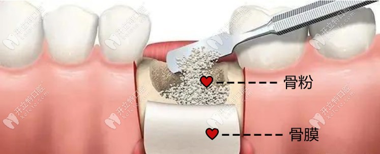 牙槽骨吸收了还可以种植牙吗骨粉骨膜了解一下
