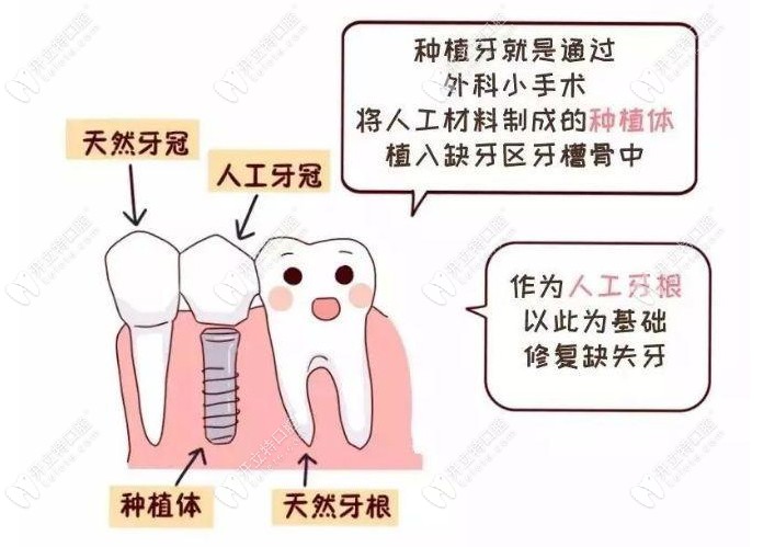 来看看什么是种植牙跟天然牙的区别