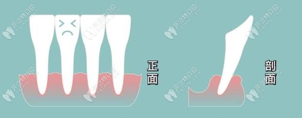 牙槽位吸收示意图
