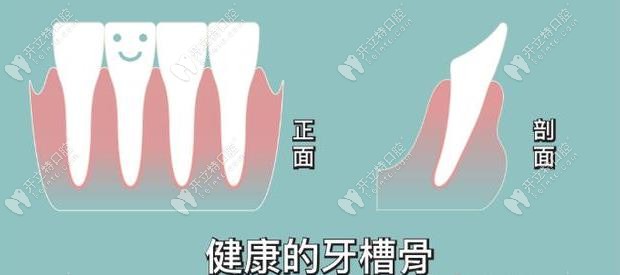牙槽骨水平吸收和垂直吸收的治疗方式一样吗?是否能恢复