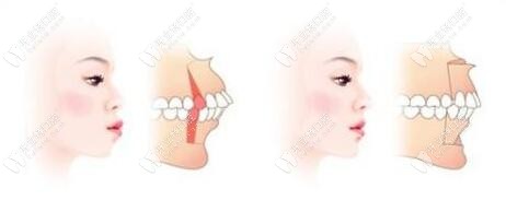 骨性龅牙凸嘴怎么改善