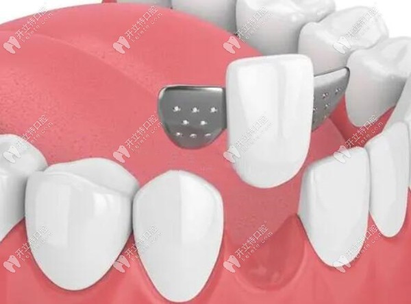 马里兰桥牙齿修复的优缺点
