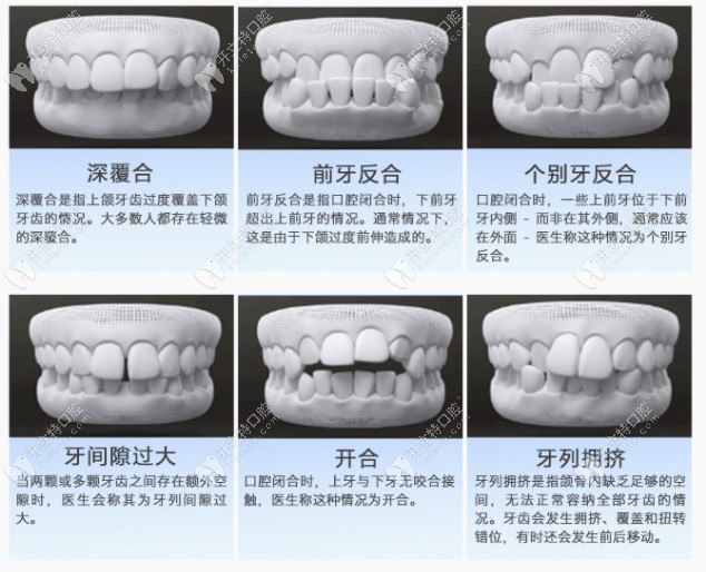 可以做矫正的一些牙齿情况介绍
