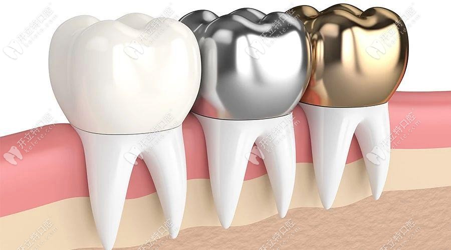 各种牙冠材质的优缺点