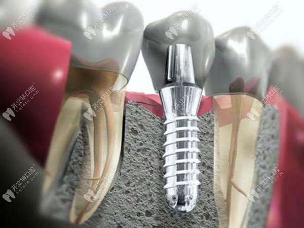 种植牙是建立在健康的牙周基础上
