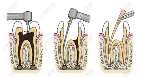 根管治疗的过程示意图