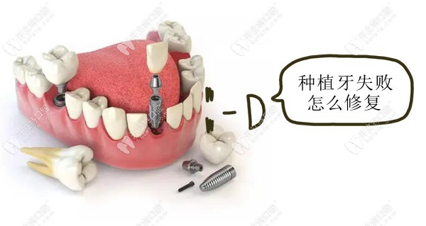 如果种植牙失败了该怎么修复