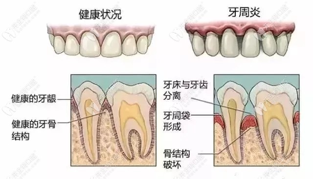 健康牙齿和牙周炎的区别
