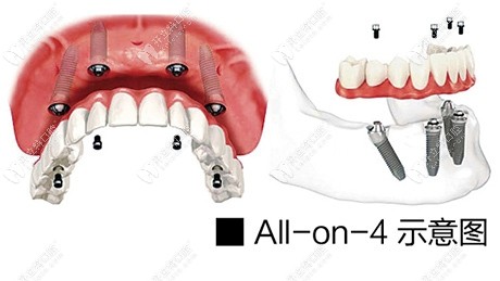 all-on-4半口种植牙