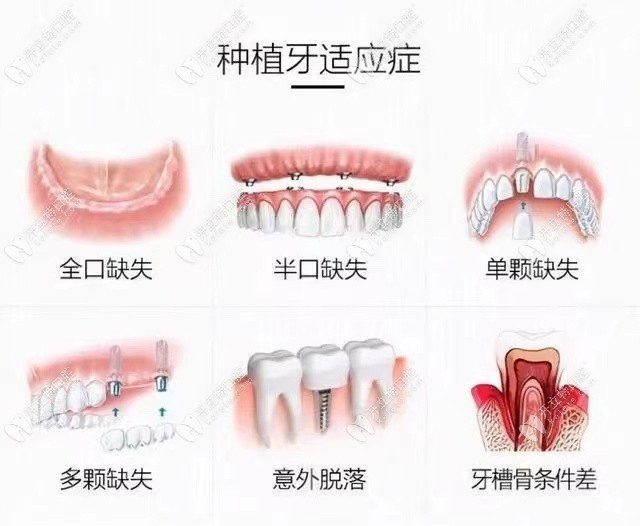 看看种植牙的适应症有哪些