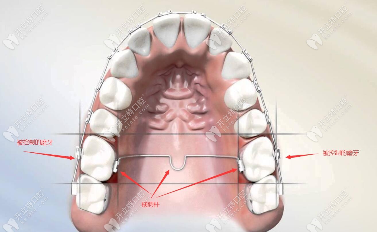 牙齿正畸中有必要用tpa吗?是否需要戴到矫正结束