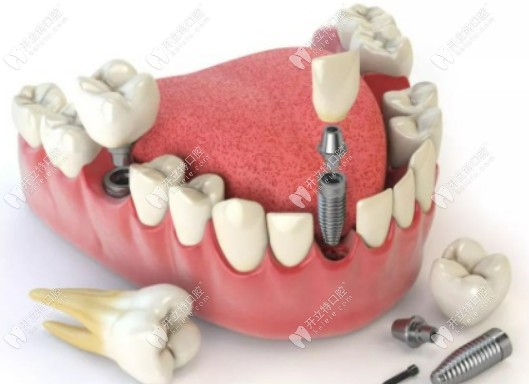 南京美莱口腔的种植牙技术