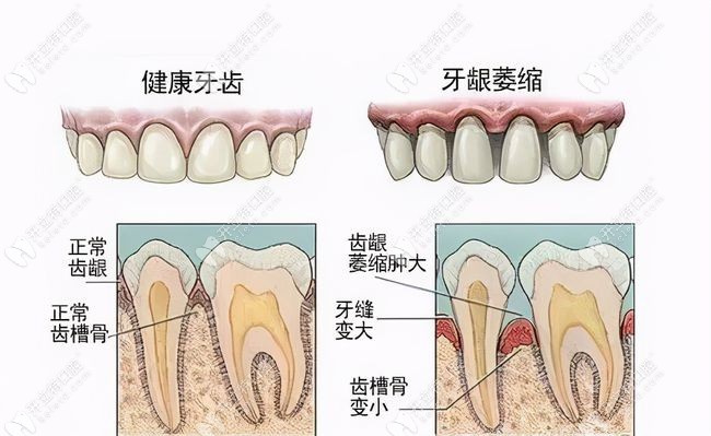 牵引成骨术和引导骨组织再生术都可用于牙槽骨条件差病例