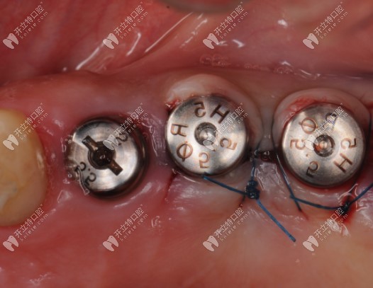 右边两颗就是埋入式植体二期手术后的示意图