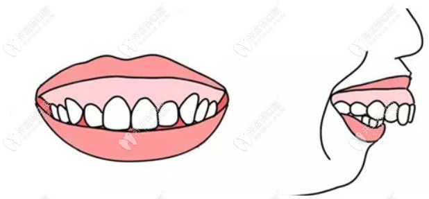 露牙龈笑是骨性还是牙性