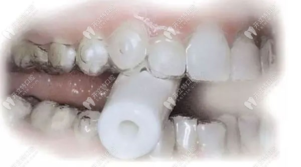 隐形牙套咬胶越多越好吗?咬肌肥大或恢复牙套脸是咬多了吗