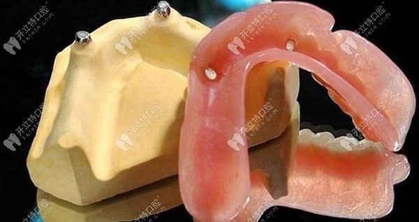 覆盖性义齿