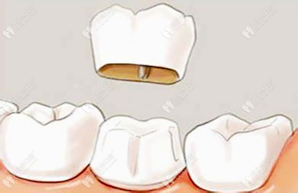 根管治疗后选择牙冠修复