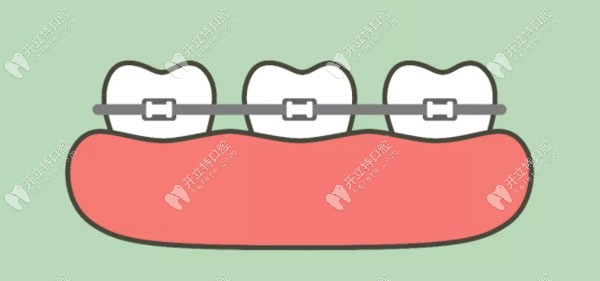 戴牙套时牙疼或牙痒是在移动