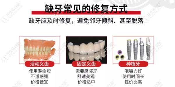 缺牙常见的3种修复方式