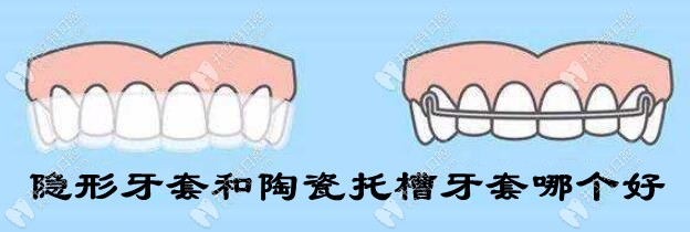 陶瓷托槽牙套和隐形牙套哪个好？它们的区别可不止价格
